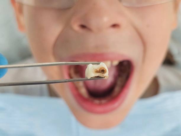 Best Emergency Dental Care for Abscessed Tooth in Mount Olive, IL